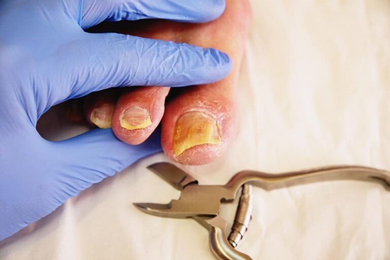 The Best Treatments for Nail Fungus, According to Dermatologists