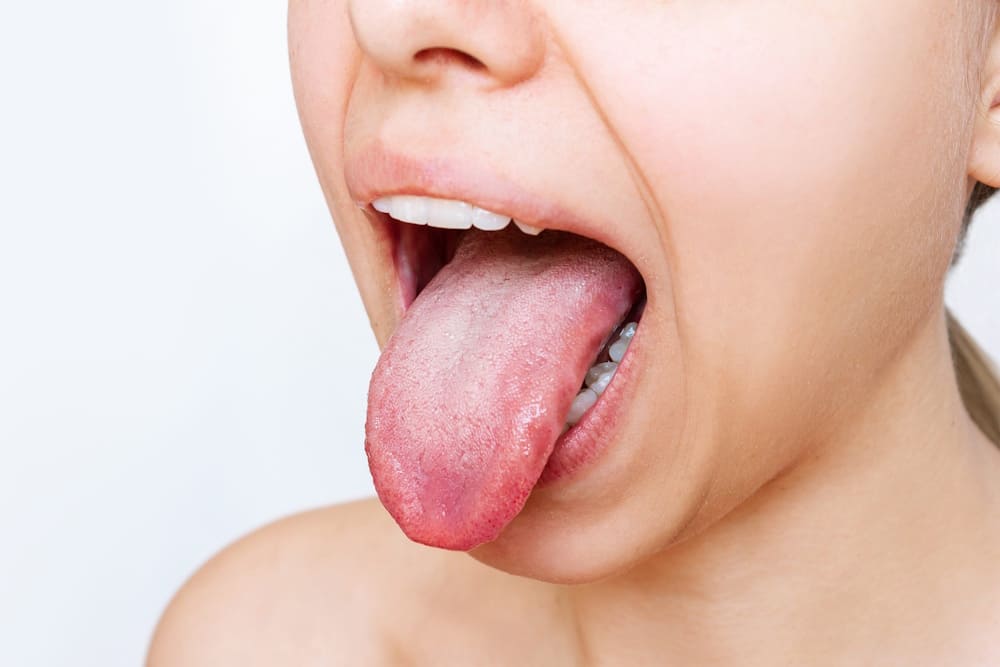 Treating Thrush in Adults: A Complete Guide