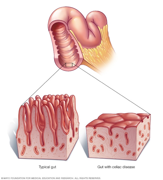 Comparison of a typical gut with healthy villi and a gut with celiac disease showing damaged, flattened villi.