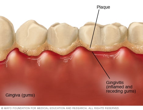 An illustration showing plaque buildup on teeth causing inflamed and receding gums, a condition known as gingivitis.
