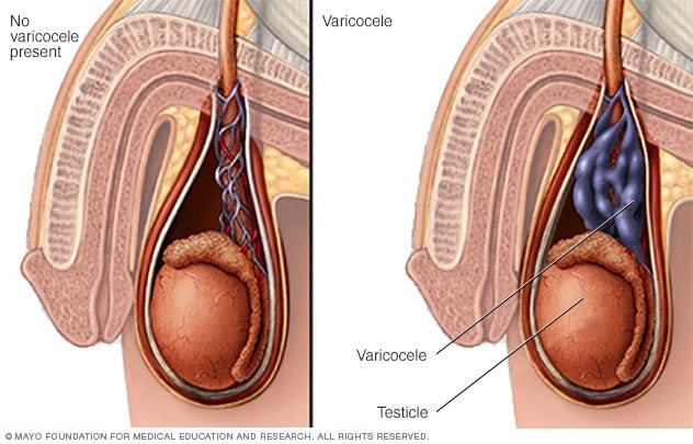 Illustration comparing a normal testicle with one affected by a varicocele.