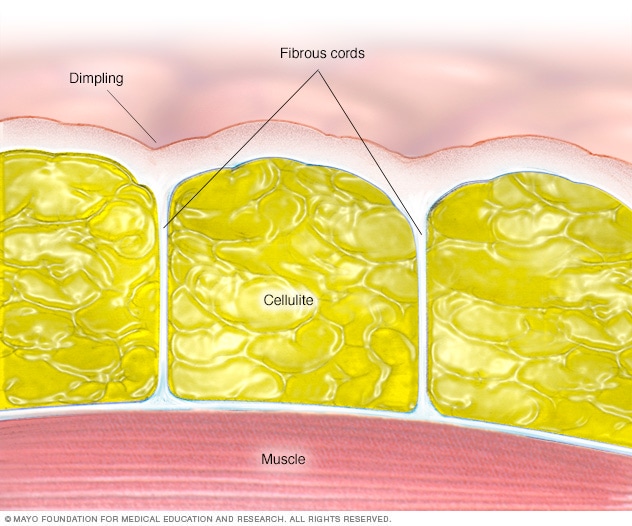 Anatomical illustration showing how fat cells push against the skin while connective cords pull down, creating cellulite.