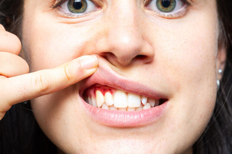 Gingivitis vs. Periodontitis: What's the Difference?