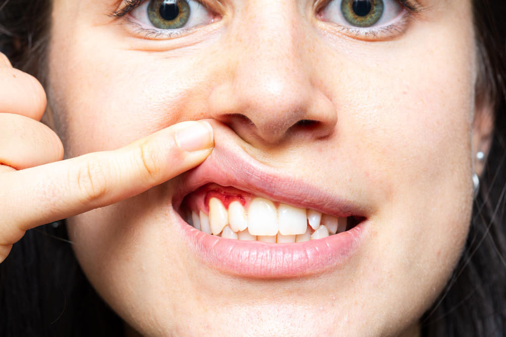 Gingivitis vs. Periodontitis: What's the Difference?