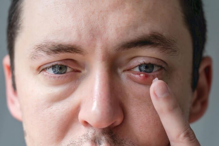How to Get Rid of a Stye Fast: 8 Home Remedies