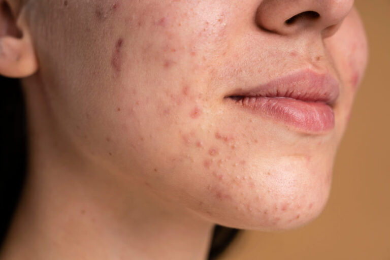 How to Get Rid of Acne Fast: A Dermatologist's Guide