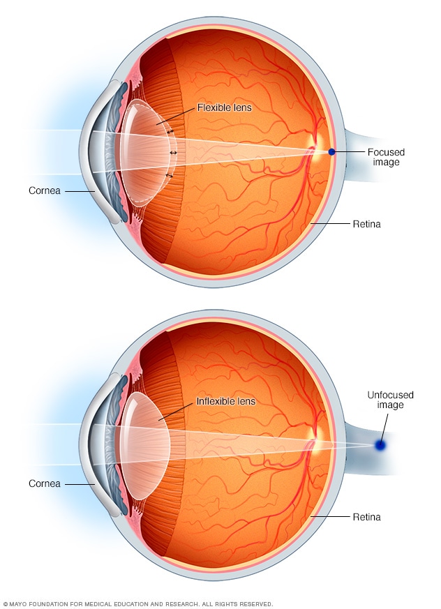 Diagram showing how presbyopia affects focus.