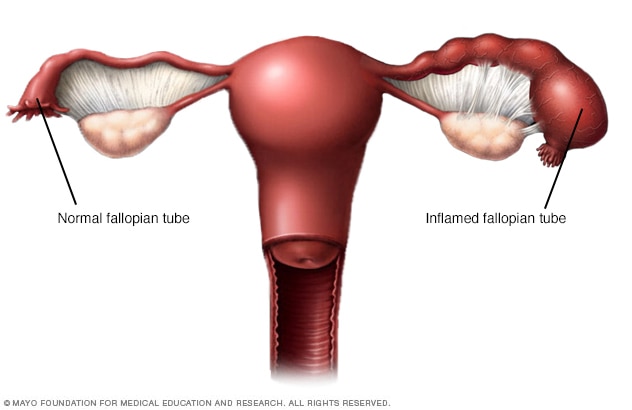 Illustration comparing a normal fallopian tube with an inflamed fallopian tube due to Pelvic Inflammatory Disease.