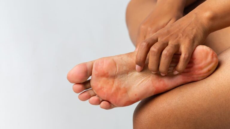 The Best Over-the-Counter Treatments for Athlete's Foot