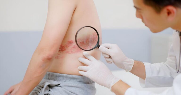 What is Shingles? A Complete Guide to the Painful Rash