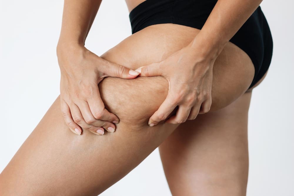 What Really Causes Cellulite? A Doctor Explains