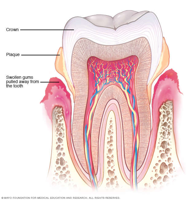 Illustration of a tooth with plaque buildup and swollen gums, showing the effects of periodontitis.