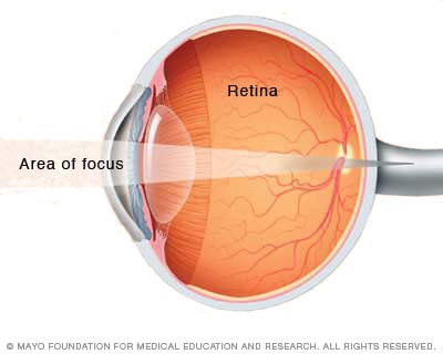 Farsightedness (Hyperopia) Illustration showing how light focuses behind the retina in a farsighted eye.