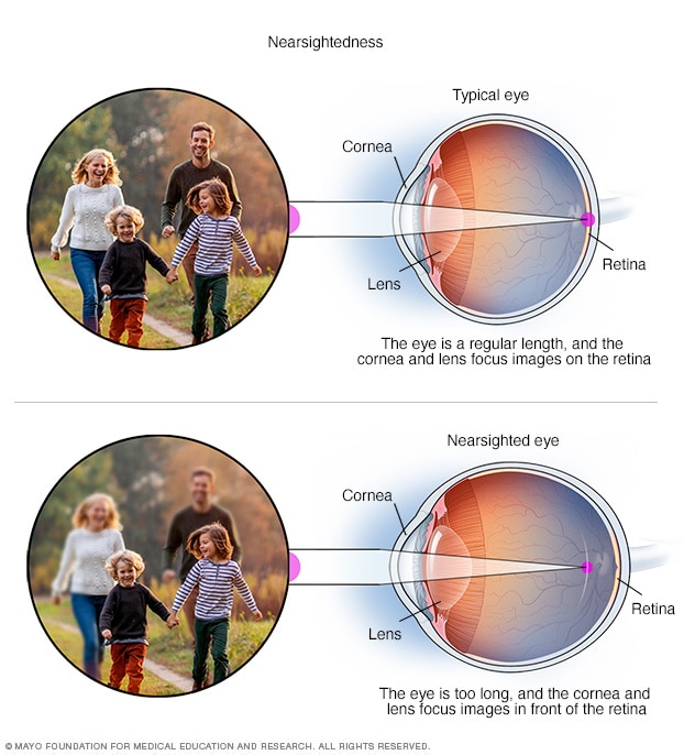 Nearsightedness Diagram