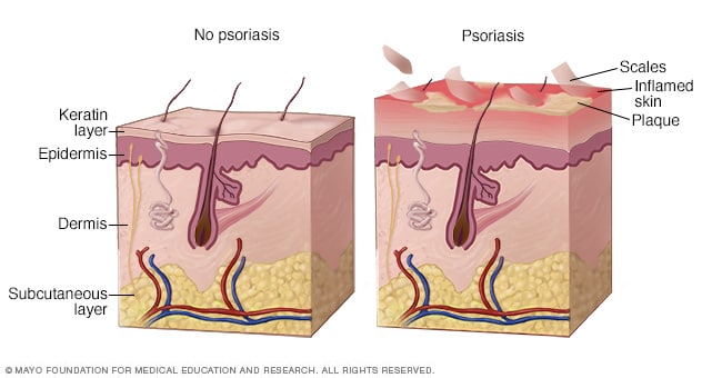 Illustration showing how the accelerated life cycle of skin cells in psoriasis leads to the buildup of dead cells and the formation of plaques.
