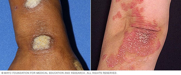 Two images showing plaque psoriasis on dark skin (wrist) and light skin (elbow), both with thick, scaly patches.