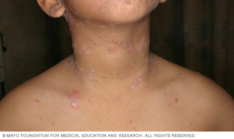 Small, drop-shaped red spots of guttate psoriasis on a person's chest and neck.