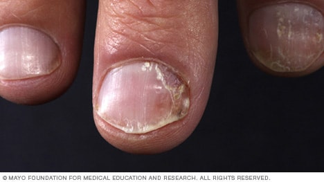 Close-up of fingernails showing pitting, discoloration, and crumbling characteristic of nail psoriasis.