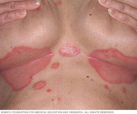 Smooth, red, inflamed patches of inverse psoriasis in the skin folds under the breast.