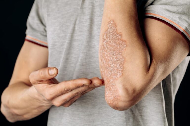 Psoriasis: Causes, Symptoms, and Treatment