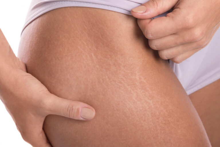 Red vs. White Stretch Marks: A 2025 Treatment Guide