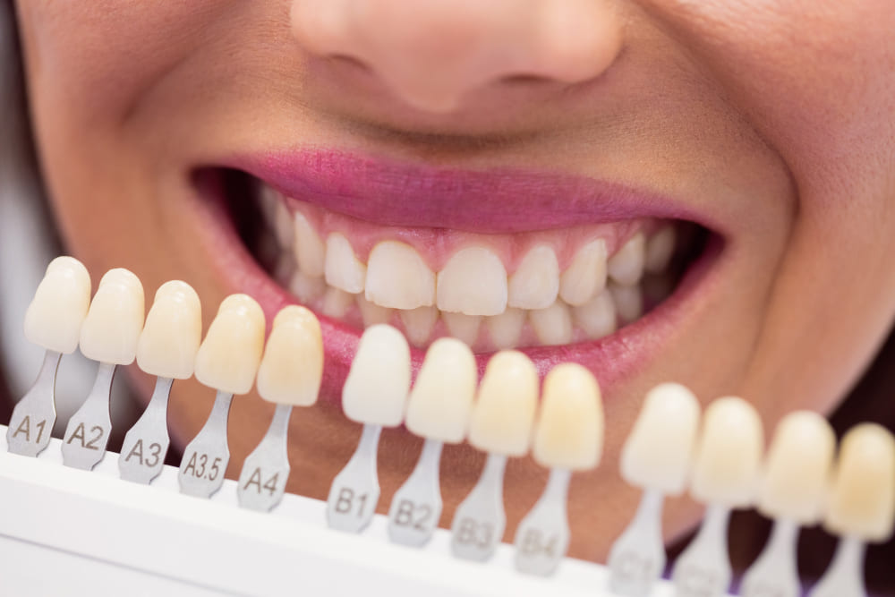 Teeth Whitening Blueprint: At-Home vs. Professional Options