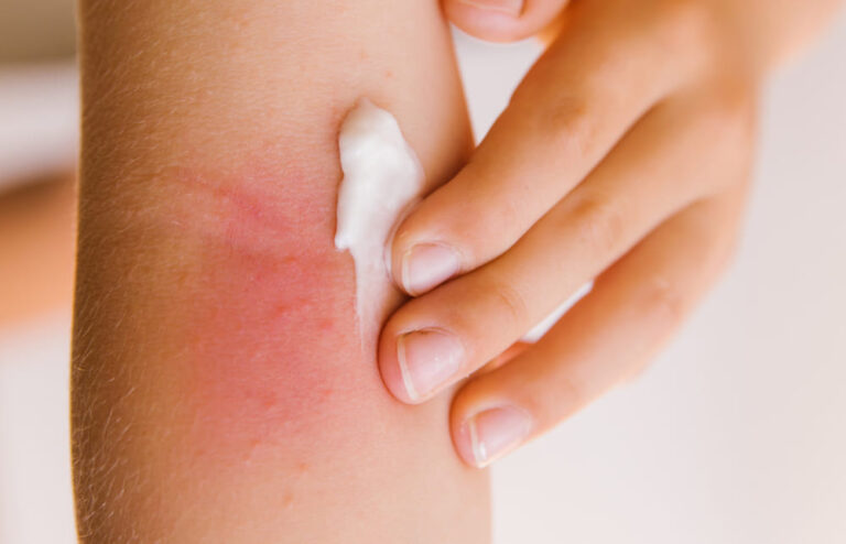 Terbinafine Cream: Your Guide to Treating Ringworm & Foot Fungus
