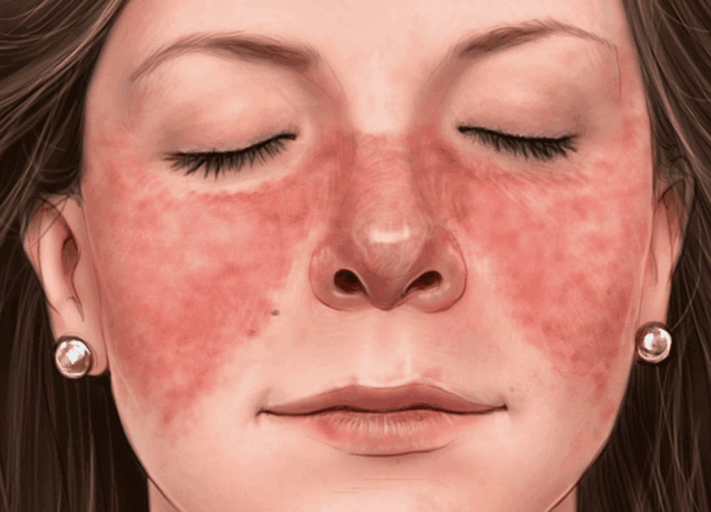 The 11 Common Symptoms of Lupus You Should Know