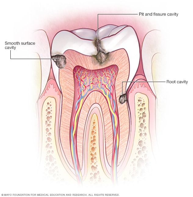 Types of Cavities Illustration showing the three types of cavities: smooth surface, root, and pit and fissure.