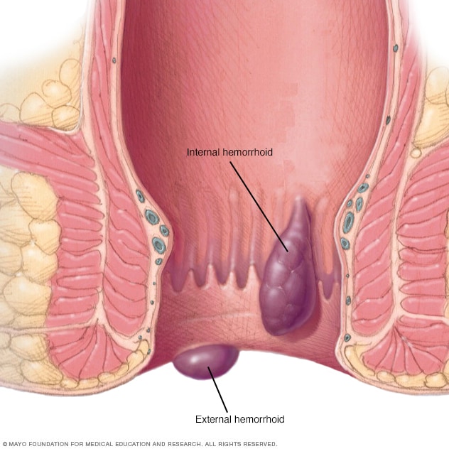 Internal vs. External Hemorrhoid Anatomy